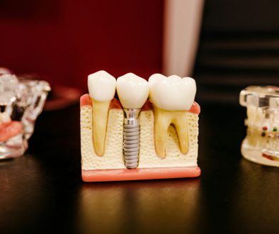 dental model with implant